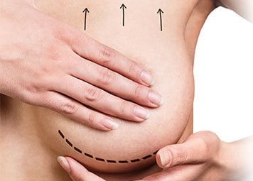 Breast Lift